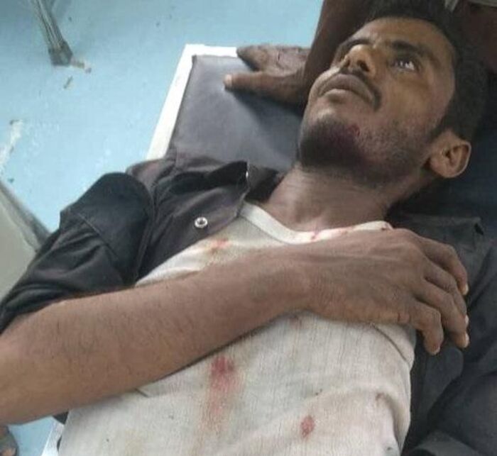 إصابة مواطن بانفجار لغم حوثي غداة جرح طفل بحيس بالحديدة