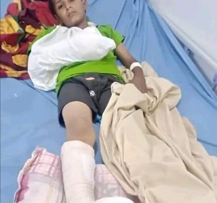 الضالع.. إصابة طفلين بانفجار مقذوف من مخلفات الحرب