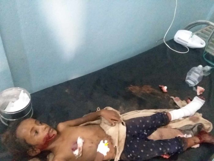 إصابة طفلتين ومسنّة بلغم حوثي محرّم دولياً في الحديدة
