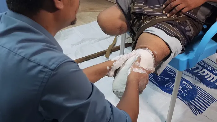 انطلاق المرحلة الثالثة من مشروع تركيب الأطراف الصناعية لضحايا ألغام الحوثيين في مستشفى المخا