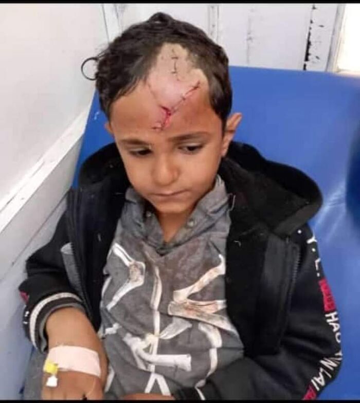 صورة| الضالع.. كلب مسعور يعض طفل وسط مدينة دمت