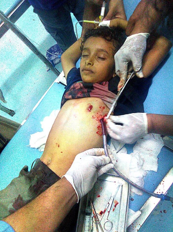 حيس | قناص حوثي يصيب طفلاً نازحاً أثناء لعبه في حي المغل