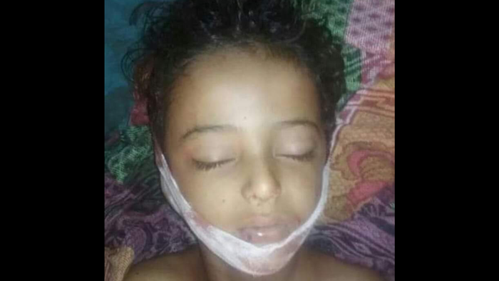 صورة - #الضالع | استشهاد طفلة برصاص قناص حوثي في #شعب_الأسود