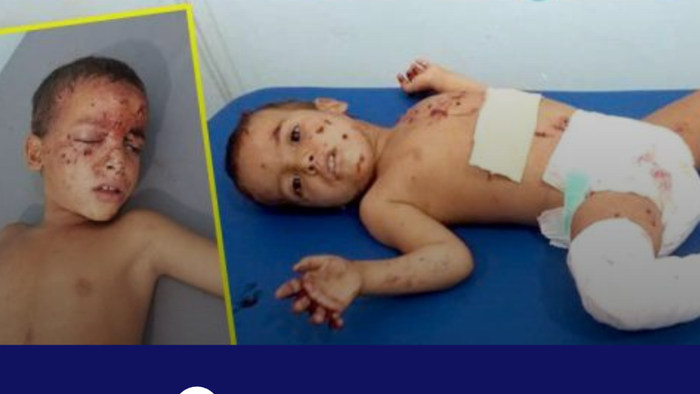 الجوف | جرح طفلين بقذيفة حوثية في قرية الغيل
