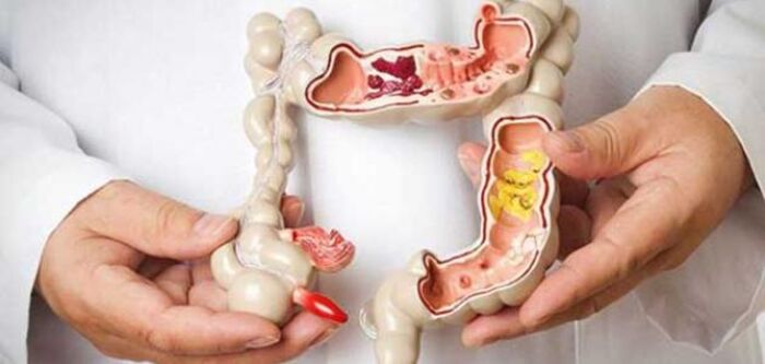 علماء: تناول المضادات الحيوية يزيد من خطر الإصابة بسرطان الأمعاء