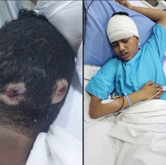 إصابة طفل بالرأس برصاص مسلح يتبع قياديا حوثيا في الحديدة